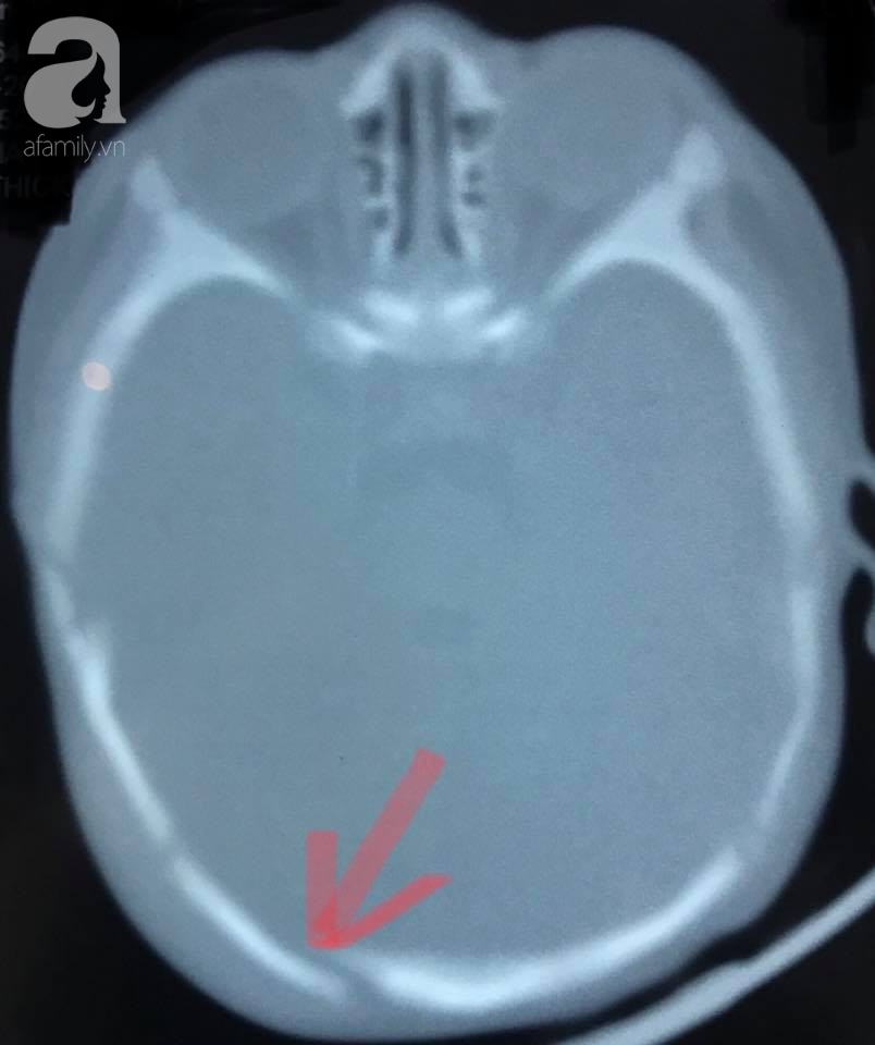 TP.HCM: Cha không giữ được bình tĩnh, lỡ taylàm con trai 2 tháng tuổi xuất huyết não vì quấy khóc không chịu ngủ