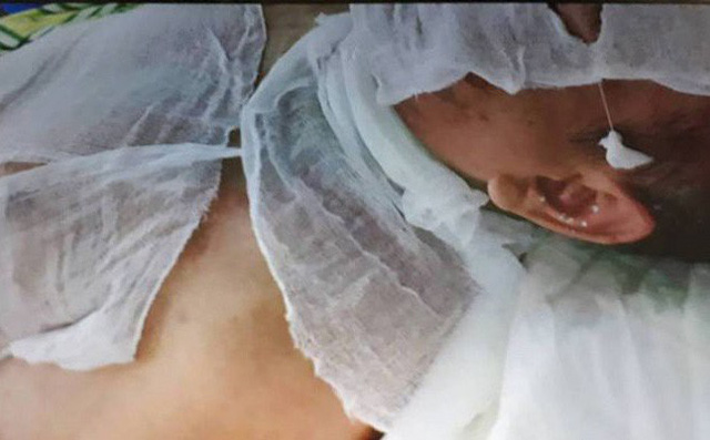 Bắt giữ nghi phạm tạt axit khiến 2 người đàn ông bị bỏng nặng ở Thái Bình