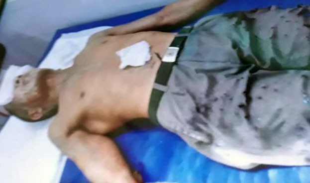 Bắt giữ nghi phạm tạt axit khiến 2 người đàn ông bị bỏng nặng ở Thái Bình