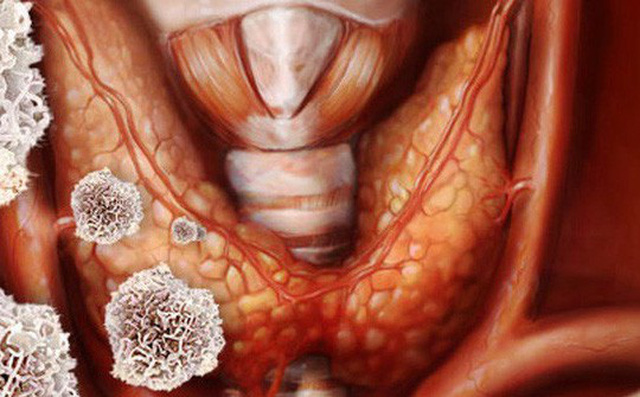 Khó nuốt khi ăn: Dấu hiệu bệnh ung thư rất nguy hiểm nhiều người thường bỏ qua