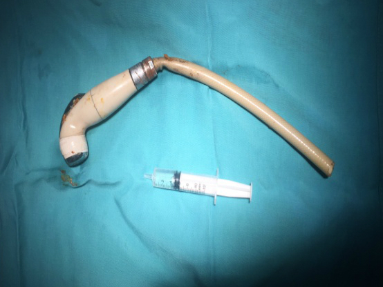 Vòi xịt vệ sinh kẹt trong hậu môn thanh niên 18 tuổi