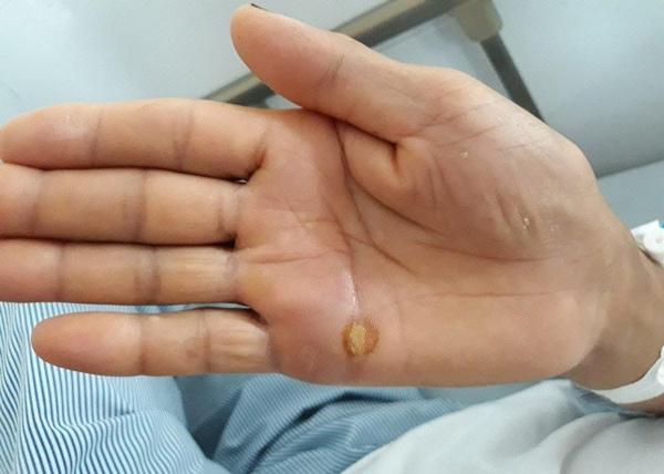 Cứng hàm, mất cảm giác vì vết thương nhỏ như đầu tăm đâm vào bàn tay