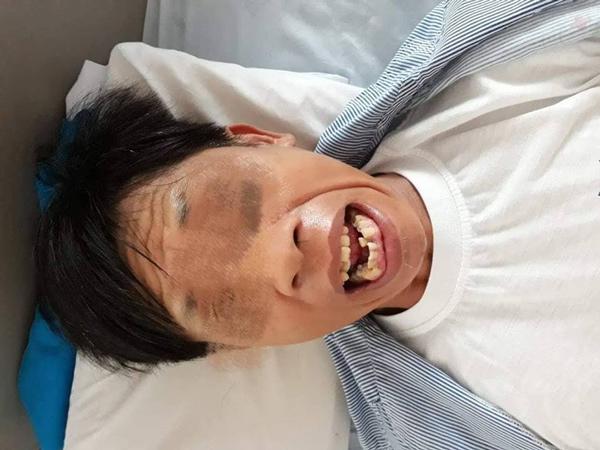 Cứng hàm, mất cảm giác vì vết thương nhỏ như đầu tăm đâm vào bàn tay