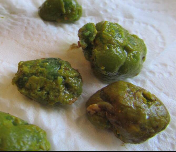 Cảnh báo: Nghe lời đồng nghiệp ăn kiểu này để giảm cân, người phụ nữ bị 200 viên sỏi trong túi mật