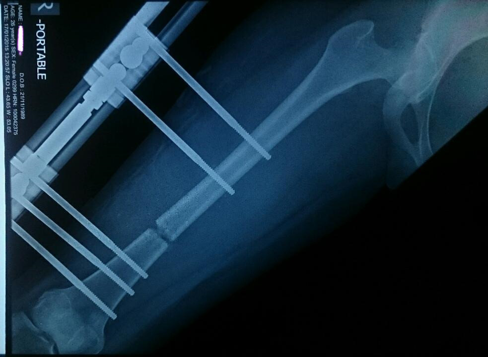 Kéo dài chân - quy trình lạnh gáy