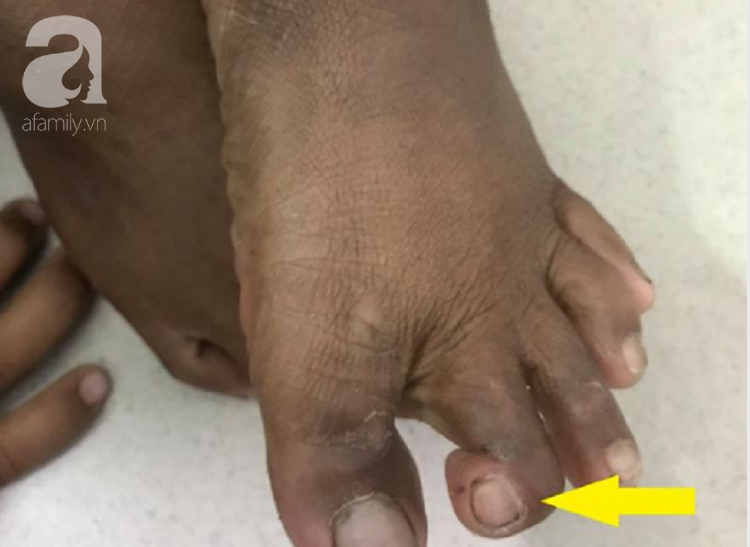 Chạy bắt ếch khi theo cô làm rẫy, bé trai 7 tuổi ở Ninh Thuận bị rắn độc tấn công