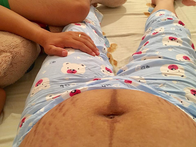 Mẹ bỉm sữa sau sinh cả tháng chẳng dám soi gương: Bụng rạn nứt, đầu tóc hôi mù, chua chua, chồng ôm cũng chả dám cho gần