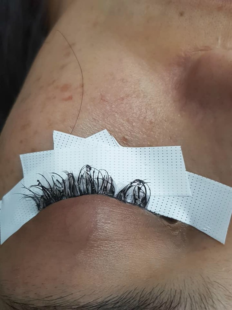 Cô gái đau đớn lĩnh hậu quả với đôi mắt sưng húp, rụng sạch lông mi vì nối mi bằng keo dán sắt Cô gái đau đớn lĩnh hậu quả với đôi mắt sưng húp, rụng sạch lông mi vì nối mi bằng keo dán sắt