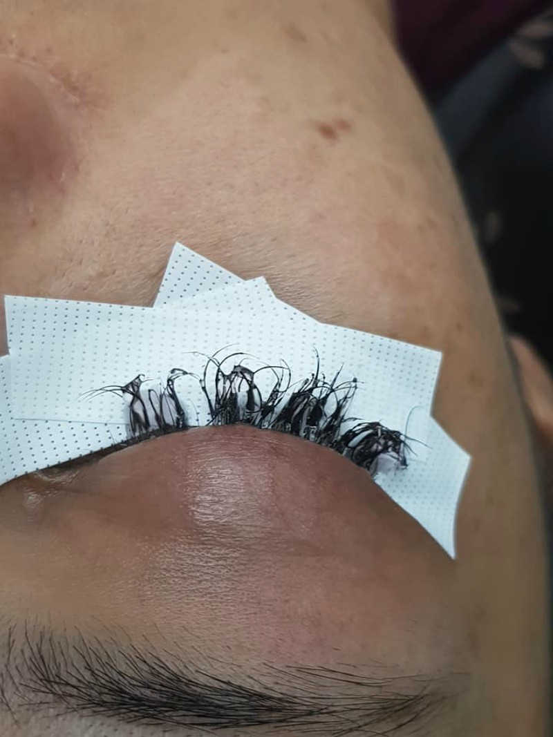 Cô gái đau đớn lĩnh hậu quả với đôi mắt sưng húp, rụng sạch lông mi vì nối mi bằng keo dán sắt Cô gái đau đớn lĩnh hậu quả với đôi mắt sưng húp, rụng sạch lông mi vì nối mi bằng keo dán sắt