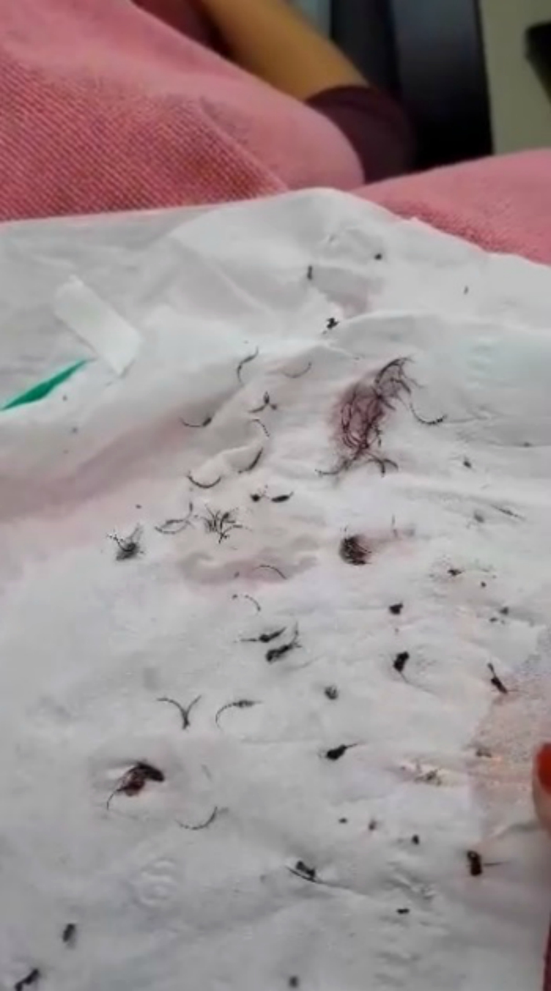 Cô gái đau đớn lĩnh hậu quả với đôi mắt sưng húp, rụng sạch lông mi vì nối mi bằng keo dán sắt Cô gái đau đớn lĩnh hậu quả với đôi mắt sưng húp, rụng sạch lông mi vì nối mi bằng keo dán sắt