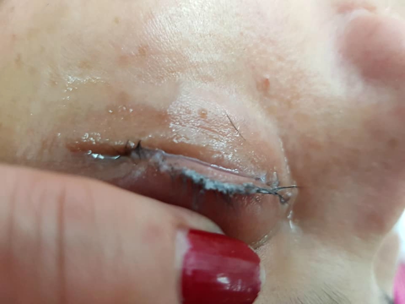Cô gái đau đớn lĩnh hậu quả với đôi mắt sưng húp, rụng sạch lông mi vì nối mi bằng keo dán sắt Cô gái đau đớn lĩnh hậu quả với đôi mắt sưng húp, rụng sạch lông mi vì nối mi bằng keo dán sắt