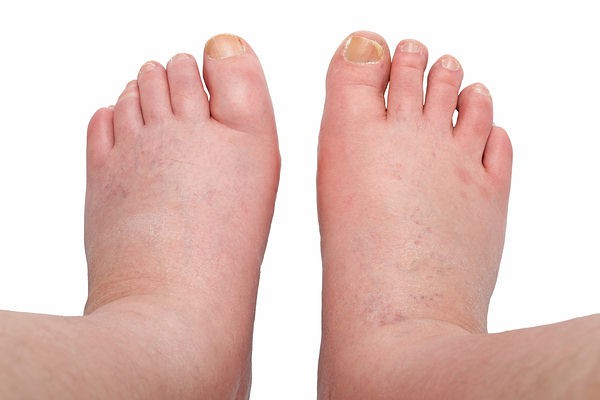 12 dấu hiệu cảnh báo gan bị tổn thương: Rất dễ nhận ra và dễ nhớ 12 dấu hiệu cảnh báo gan bị tổn thương: Rất dễ nhận ra và dễ nhớ