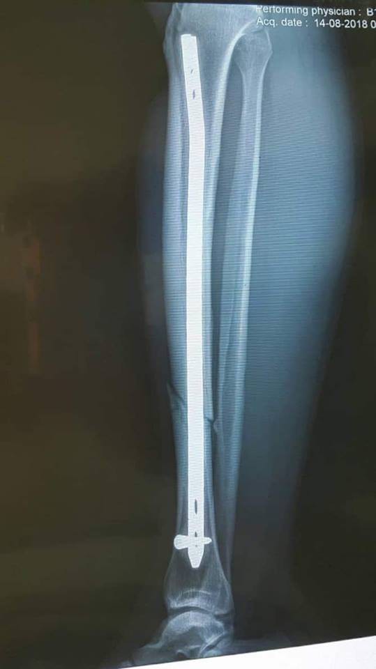 Chiến sĩ CSCĐ Hà Nội bị thiếu nữ tóc vàng tông xe vào đã ổn định sức khỏe