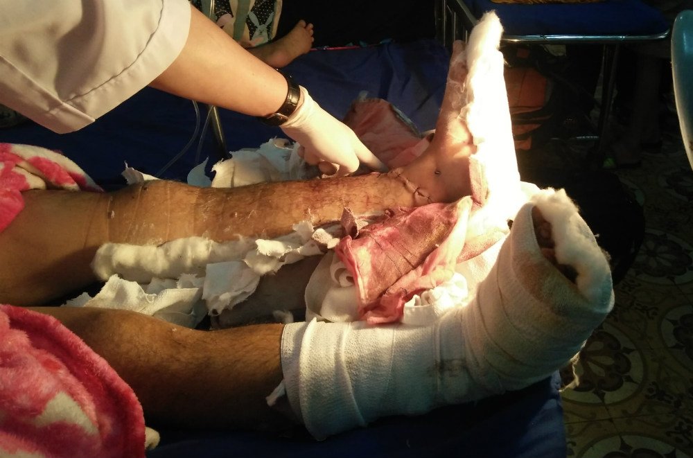 Nam thanh niên bị kẻ lạ chém đứt lìa 2 bàn chân