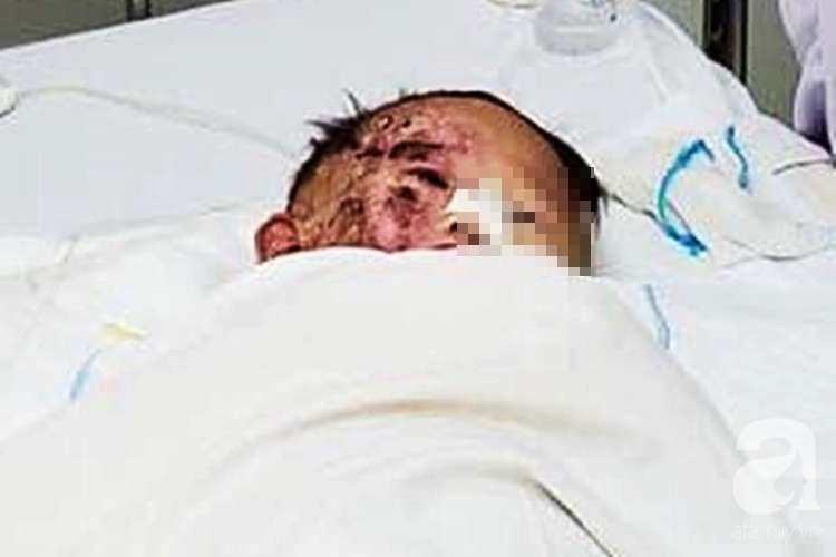 Té vào đống rác đang đốt mà không ai biết, bé trai 4 tuổi ở Phú Yên bị bỏng cực nặng phải đoạn chi