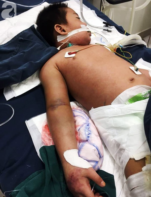 Hà Nội: Bé trai 7 tuổi đang khoẻ mạnh bỗng hôn mê vì suy đa tạng, nhiễm trùng máu sau trận sốt cao