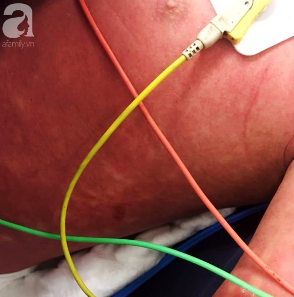 Hà Nội: Bé trai 7 tuổi đang khoẻ mạnh bỗng hôn mê vì suy đa tạng, nhiễm trùng máu sau trận sốt cao