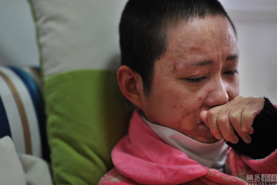 Cả gan từ chối tình cảm thiếu gia tài phiệt, cô gái bị thiêu sống tại chỗ và trải qua 7 năm đau đớn về thể xác lẫn tinh thần