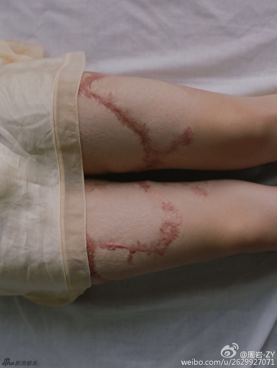 Cả gan từ chối tình cảm thiếu gia tài phiệt, cô gái bị thiêu sống tại chỗ và trải qua 7 năm đau đớn về thể xác lẫn tinh thần