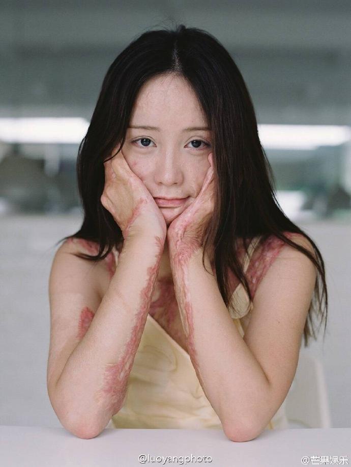 Cả gan từ chối tình cảm thiếu gia tài phiệt, cô gái bị thiêu sống tại chỗ và trải qua 7 năm đau đớn về thể xác lẫn tinh thần