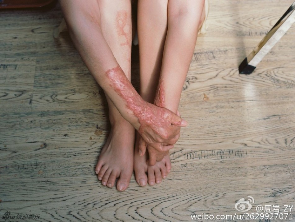 Cả gan từ chối tình cảm thiếu gia tài phiệt, cô gái bị thiêu sống tại chỗ và trải qua 7 năm đau đớn về thể xác lẫn tinh thần