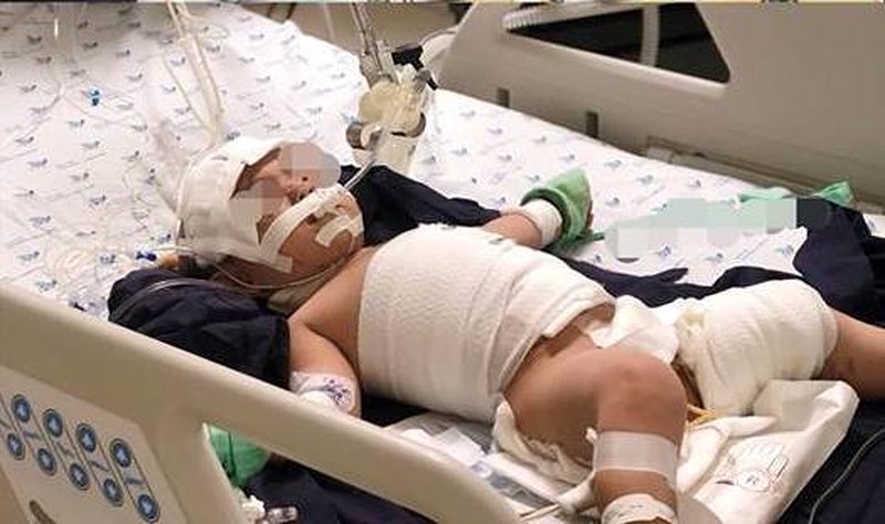 Mắc dây ấm đun siêu tốc, bé 20 tháng tuổi bỏng nặng