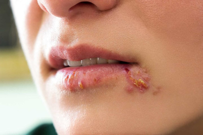 Các triệu chứng Herpes ở phụ nữ không nên bỏ qua