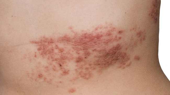 Các triệu chứng Herpes ở phụ nữ không nên bỏ qua
