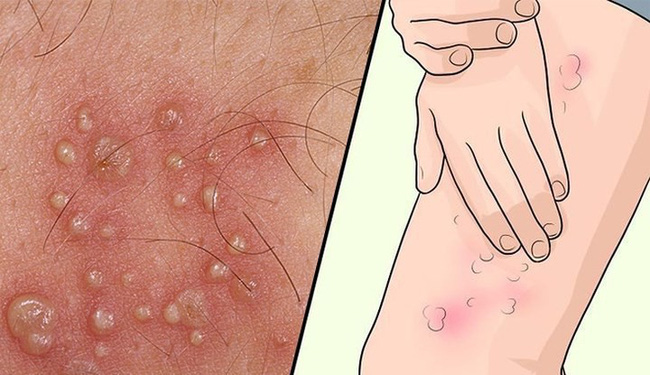 Các triệu chứng Herpes ở phụ nữ không nên bỏ qua