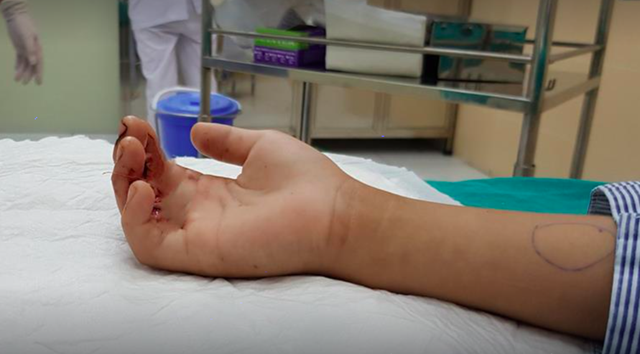 Hà Nội: Bé 9 tuổi kẹt ngón tay ở cửa thang máy