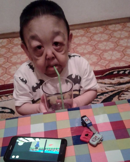 Bệnh lạ khiến bé 6 tuổi trông như ông cụ