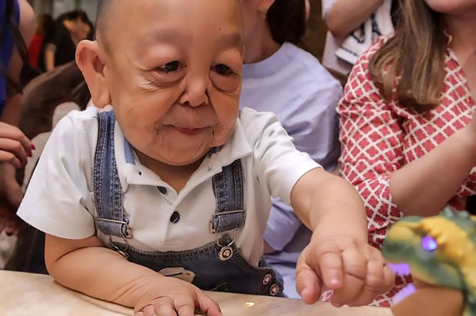 Bệnh lạ khiến bé 6 tuổi trông như ông cụ