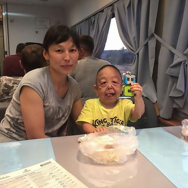 Mắc phải chứng bệnh hiếm gặp với tỉ lệ 1/50.000, cậu bé mới 6 tuổi đã có ngoại hình như một cụ ông