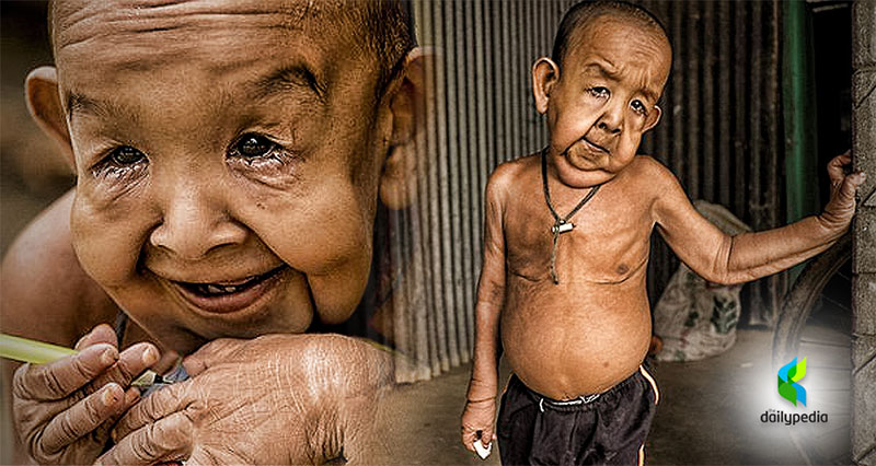 Mắc phải chứng bệnh hiếm gặp với tỉ lệ 1/50.000, cậu bé mới 6 tuổi đã có ngoại hình như một cụ ông