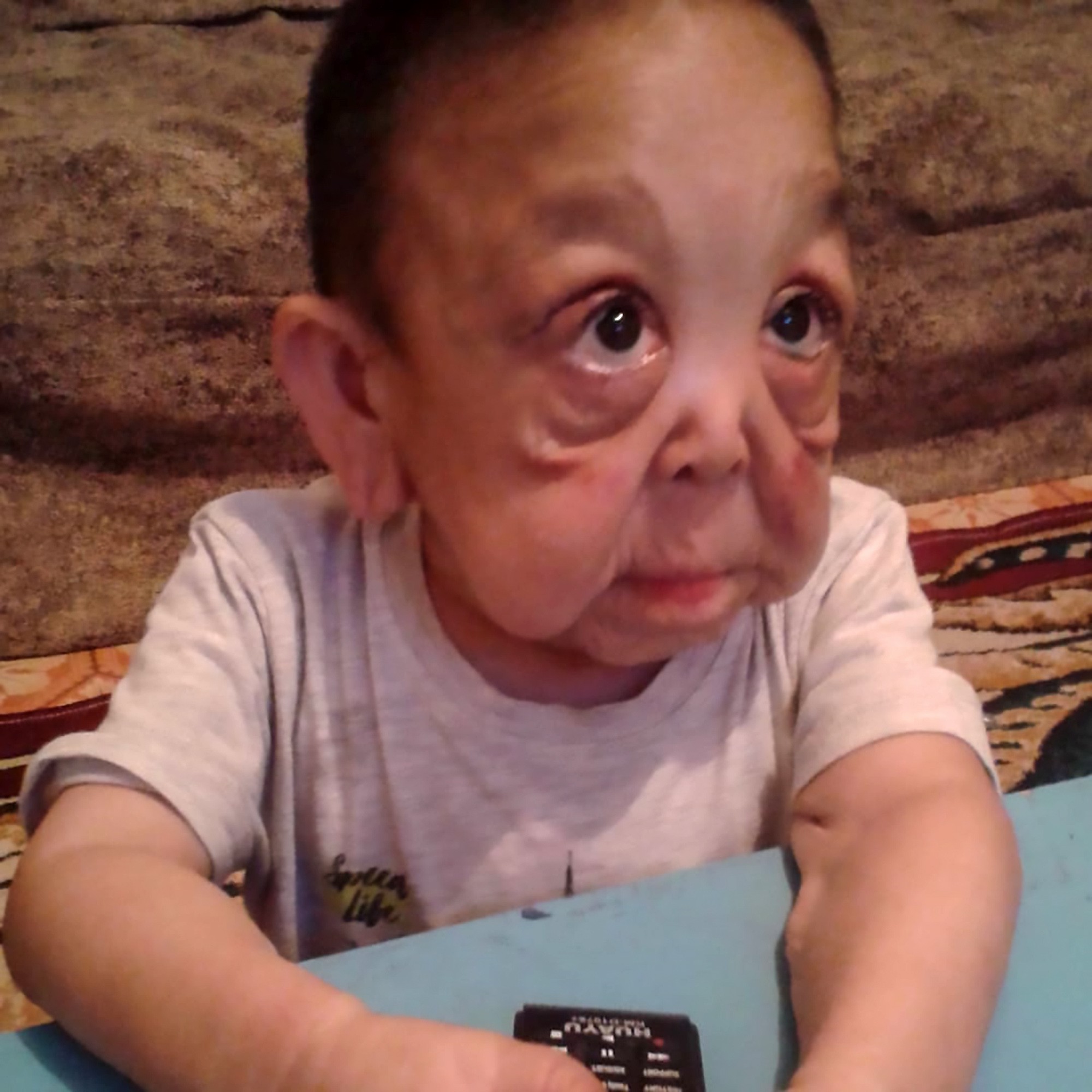 Mắc phải chứng bệnh hiếm gặp với tỉ lệ 1/50.000, cậu bé mới 6 tuổi đã có ngoại hình như một cụ ông