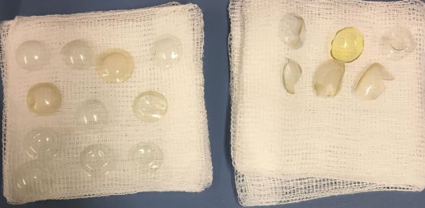 Sưng và chảy nước mắt nhiều tháng liền mà vẫn chủ quan, đến khi đi khám người phụ nữ mới té ngửa vì thứ này trong mắt suốt 28 năm