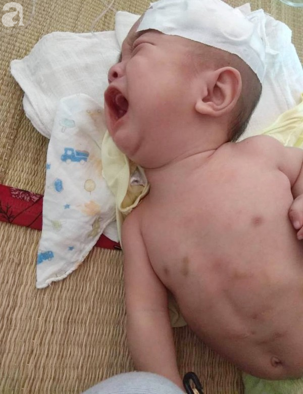 Sinh ra nặng chỉ 1kg, bé trai 14 tháng tuổi đau đớn chống chọi với căn bệnh quái ác