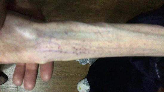 3 năm cầm chocolate chỉ để ngửi, cô gái 21 hóa bà lão 60, cơ thể chi chít vết bầm, suýt mất mạng vì 2 lần xuất huyết não