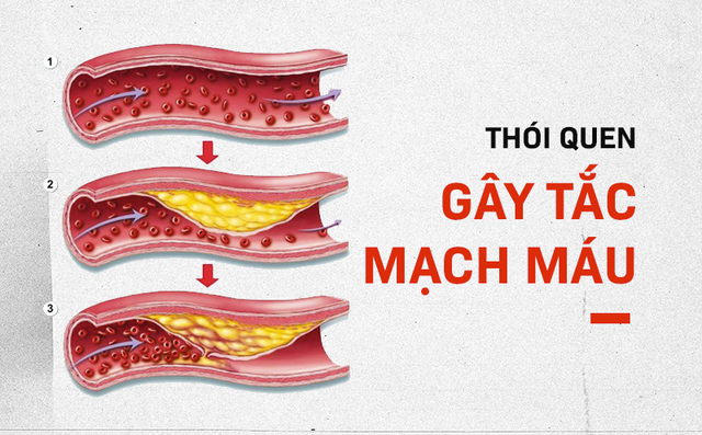 6 thói quen phá hủy mạch máu: Nguyên nhân gây đột quỵ, tử vong mà nhiều người không biết 6 thói quen phá hủy mạch máu: Nguyên nhân gây đột quỵ, tử vong mà nhiều người không biết