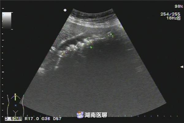 Nếu là nữ giới thì cần đặc biệt ghi nhớ những điều sau để không gặp phải sự cố kinh hoàng như người phụ nữ này