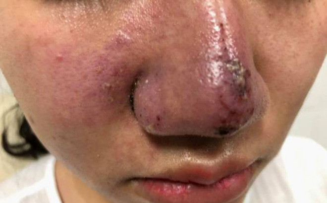 Hà Nội: Một phụ nữ méo mặt, mũi bọc mủ vì tiêm filler làm đẹp