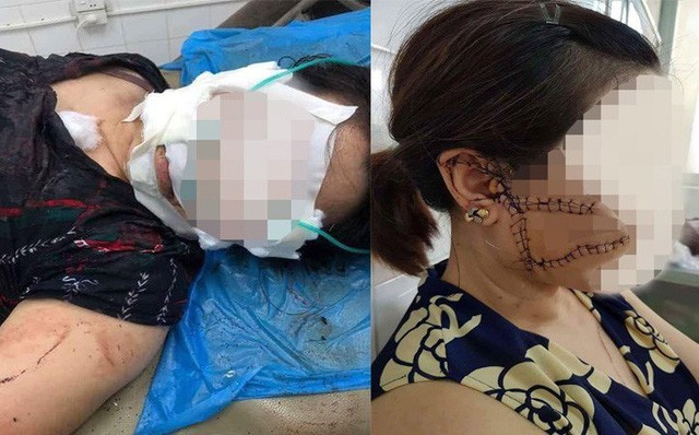 Người phụ nữ tố bị chồng ghen tuông cắt đứt 3 gân chân, rạch mặt