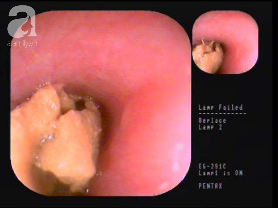 Tưởng ăn thịt heo đã nấu chín không có gì nguy hiểm nhưng vì sai lầm này, người đàn ông suýt mất mạng vì nghẹt thở