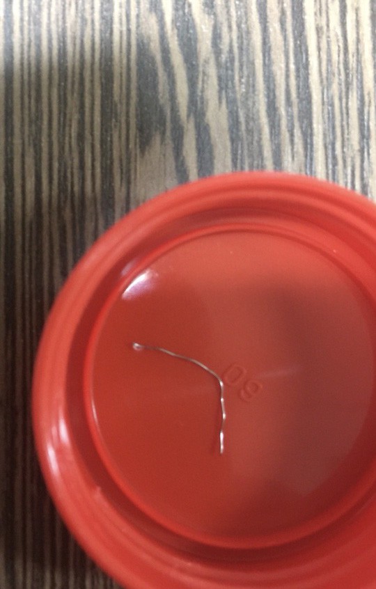 Chuyện hy hữu: Nuốt thanh kẽm dài 7 cm mà không hay biết