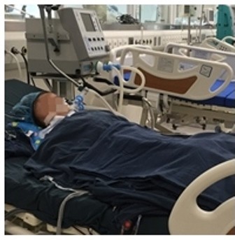 Chọc phá tổ ong, bé trai 5 tuổi suy đa phủ tạng nguy kịch