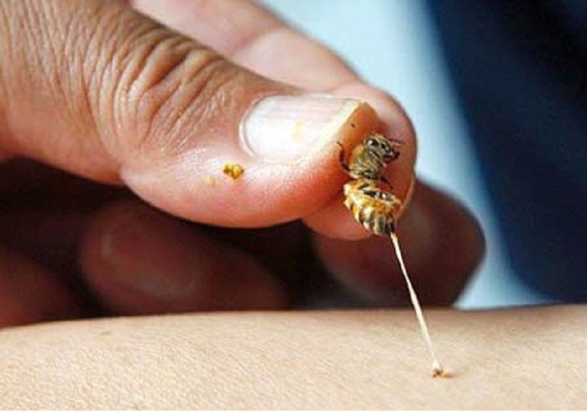 Chọc phá tổ ong, bé trai 5 tuổi suy đa phủ tạng nguy kịch