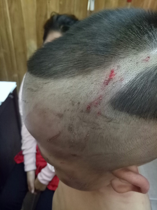 Đã có kết luận thương tích bé trai bị cha dượng đánh dã man ở Phú Quốc