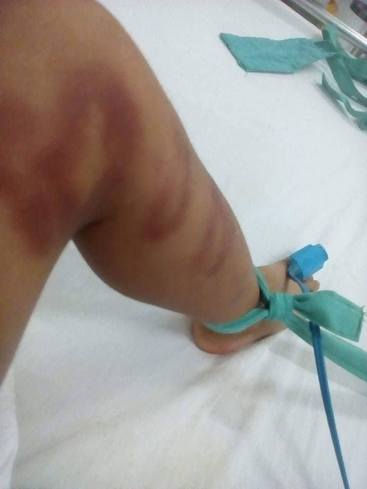 Bé trai 4 tuổi nguy kịch do người tình của mẹ bạo hành dã man