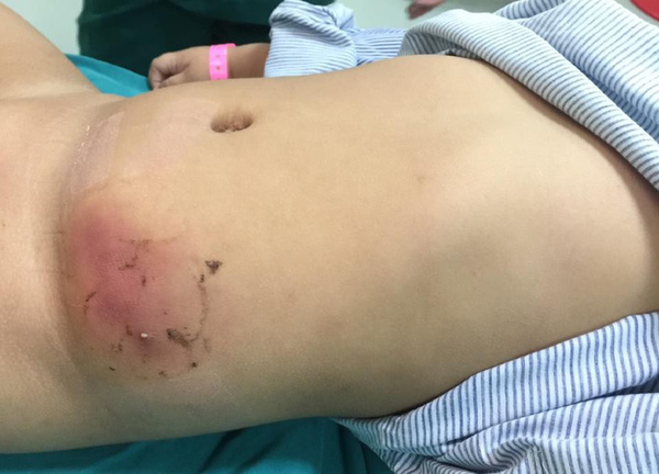 Con bỗng hoại tử vùng bụng do mẹ dán loại cao phổ biến trị mụn