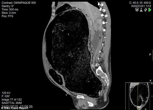 Đau bụng, tiêu chảy 1 tuần, người đàn ông suýt mất mạng vì đại tràng quá tải chất thải